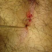 fistola sacrococcigea